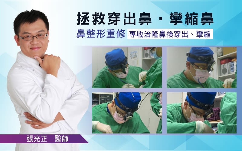 驚！越南正妹美的鼻要鼻要～凹洞鼻神再造黃金「鼻」例,手術,隆鼻,真美學診所
