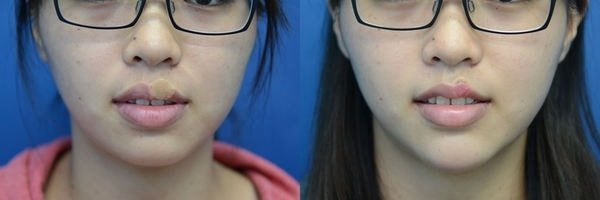 【縮唇/3D俏唇珠】醜唇形怎麼辦? 謝氏縮唇終結它!，真美學診所(對比圖)