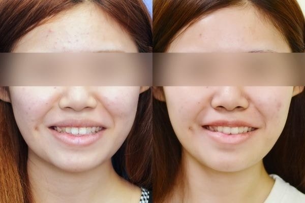 (對比圖)【加個梨窩,讓笑容更甜一點! 謝氏超自然梨渦手術!,真美學診所