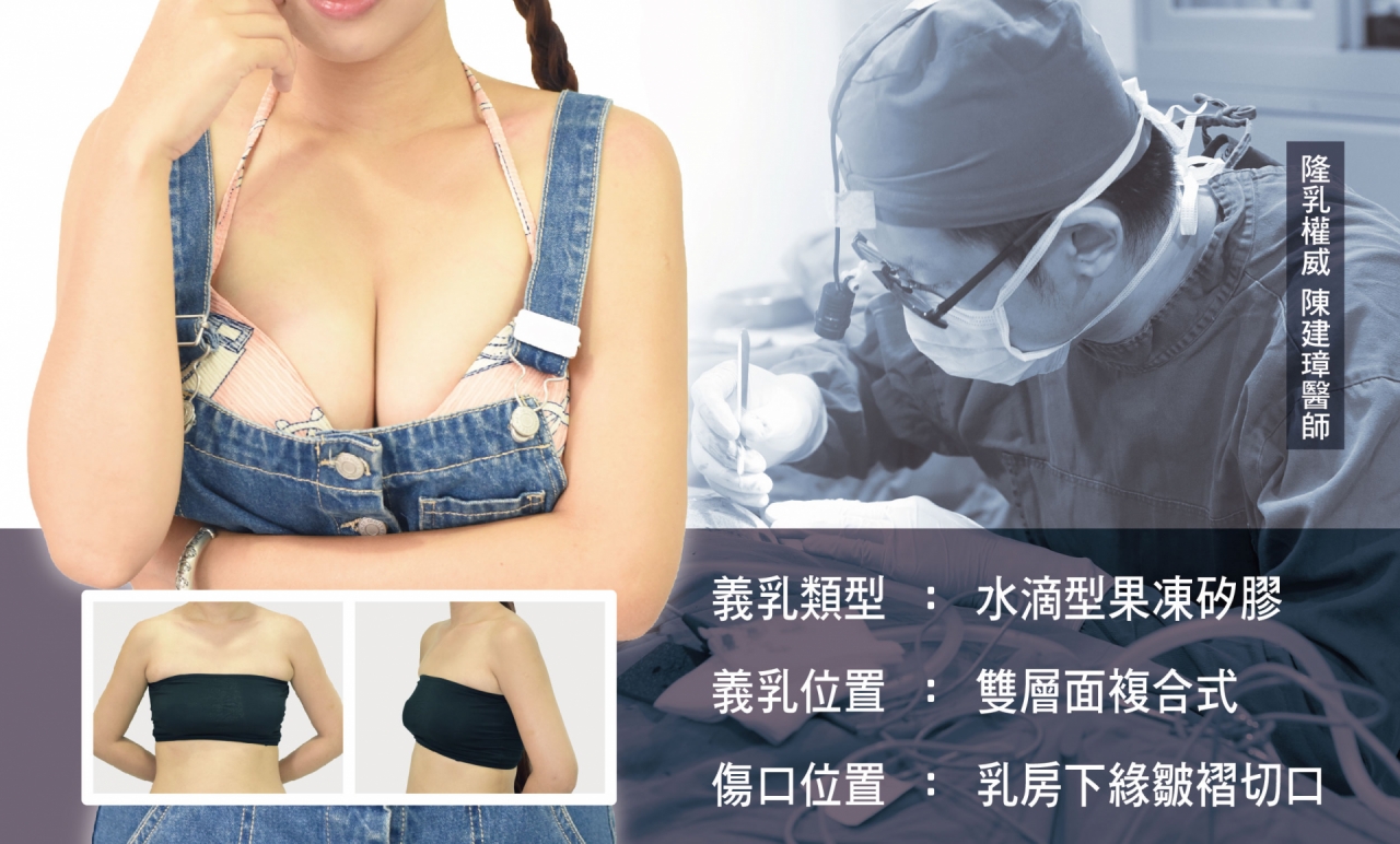 義乳的類型-水滴型果凍矽膠／義乳的位置-雙層面複合／傷口位置-乳房下緣皺褶切口，隆乳就來真美學！