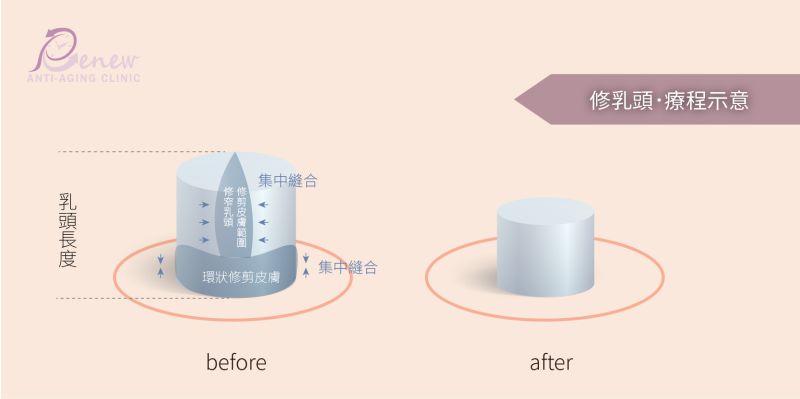 乳房重建－修乳頭的療程示意圖片 這種手術通常可在局部麻醉下施行，也可在全身麻醉下，與其它乳房整形手術同時進行。手術傷口疤痕的部份，會藏於下緣或邊緣不外露。