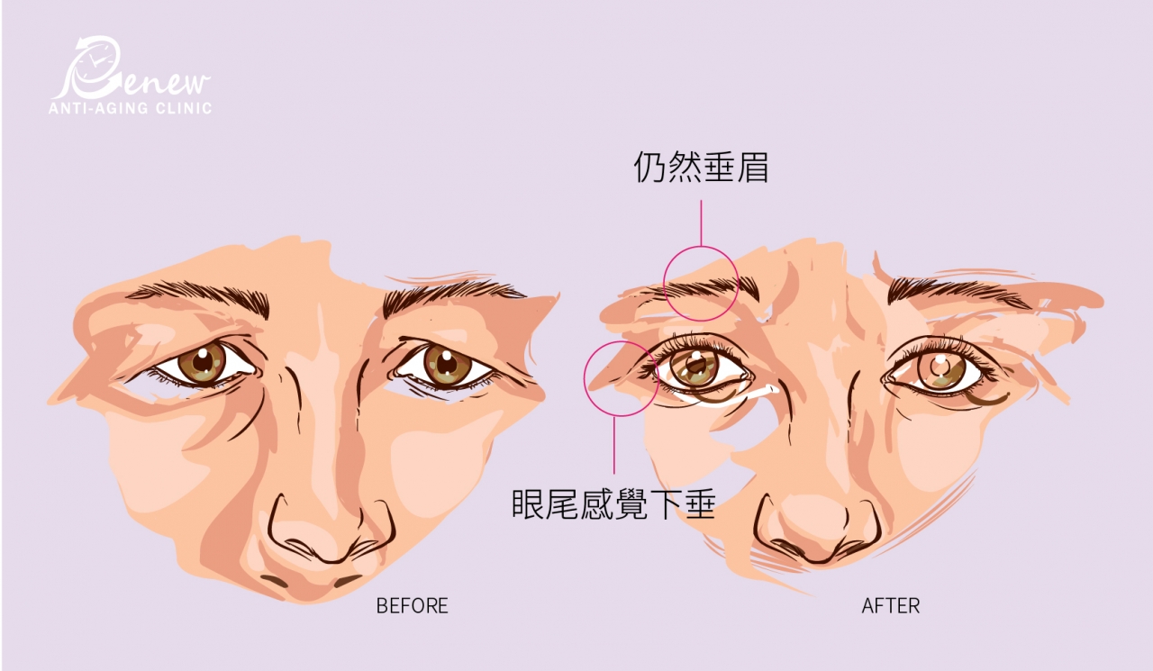隱痕提眉眼尾：擺脫倒眉垂眼問題，回歸「亮眼」美人寶座