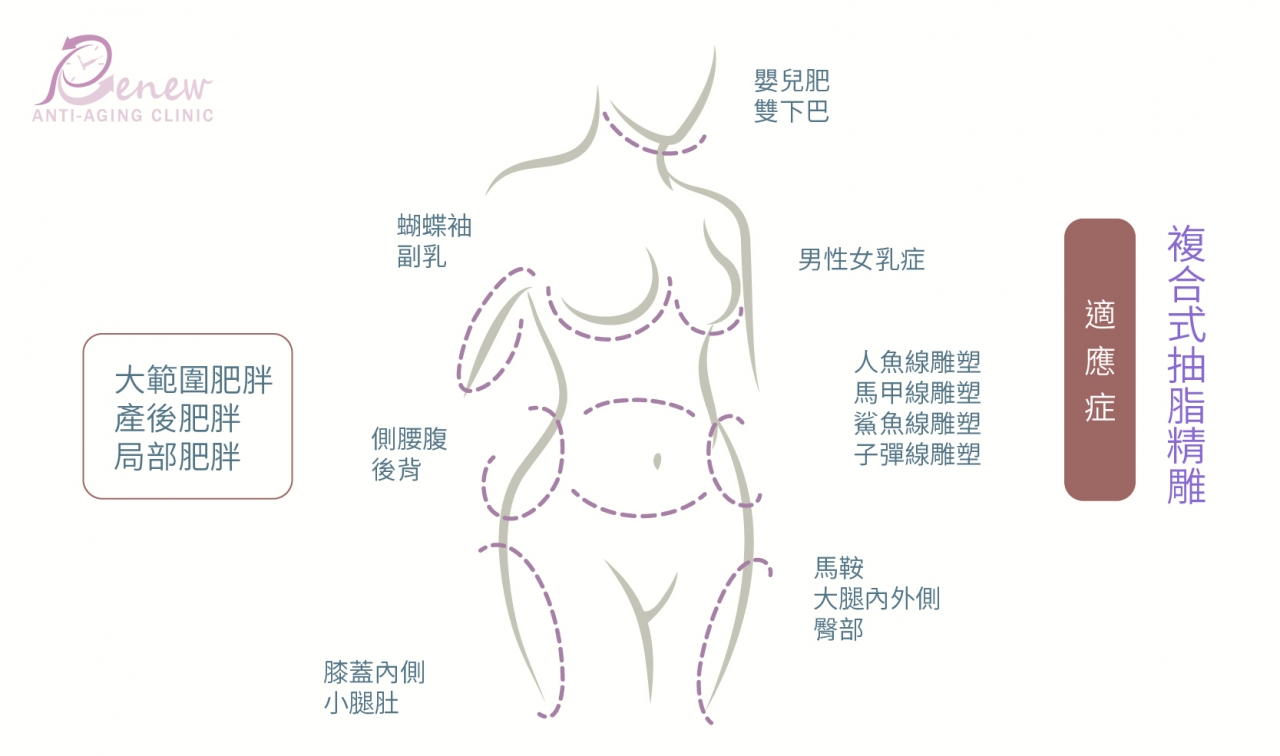 複合式抽脂精雕的適應症-大範圍肥胖-產後肥胖-局部肥胖,嬰兒肥/雙下巴,男性女乳症,蝴蝶袖/副乳,側腰腹/後背,膝蓋內側/小腿肚,馬鞍/大腿內外側/臀部,人魚線雕塑/馬甲線雕塑/鯊魚線雕塑/子彈線雕塑