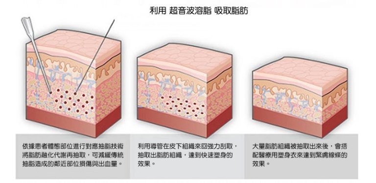 ULTRA-Z超音波抽脂手法整體來說恢復期更短，術後女性最害怕的肌膚表面松弛與凹凸不平的情況也大幅降低許多。