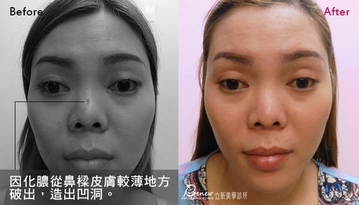 鼻整形修復二步救援，挽回9成以上受創的心靈，結構三段式隆鼻，在鼻樑放入假體，鼻頭放入耳軟骨，鼻中隔延長,(對比圖)