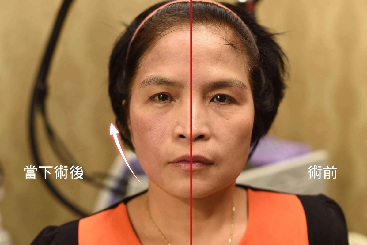 (對比圖)【美魔黃金電波】一機搞定！皺紋、凹洞疤瑕疵膚質、松垂肌 通通OUT！