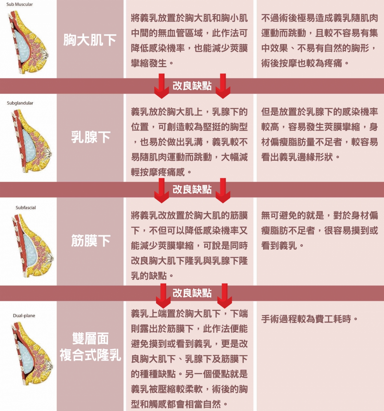 「雙層面複合式隆乳」可使胸型自然、觸感仿真,可放在胸大肌下／乳腺下／筋膜下,雙層式複合式隆乳-此作法便能避免摸到或看到義乳,更是改良其他方式隆乳的種種缺點!