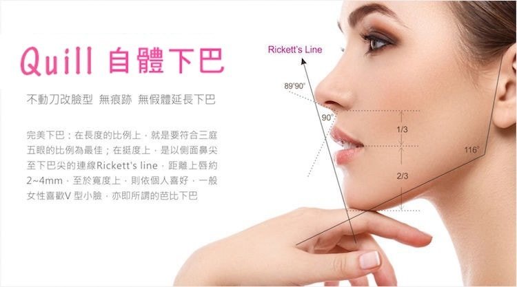 Q下巴+安全可吸收材質撐架,真美學診所,不動刀改臉型,無痕跡,無假體延長下巴