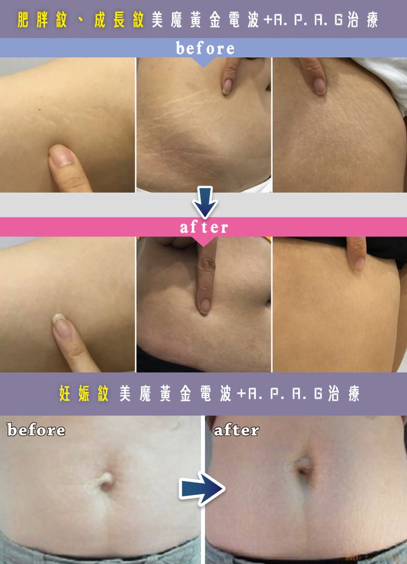 (對比圖)實現超魔鬼身材3步驟-複合式抽脂精雕術+強升8字手臂腹部大腿拉提+美魔黃金電波+APAG治療肥胖紋、成長紋