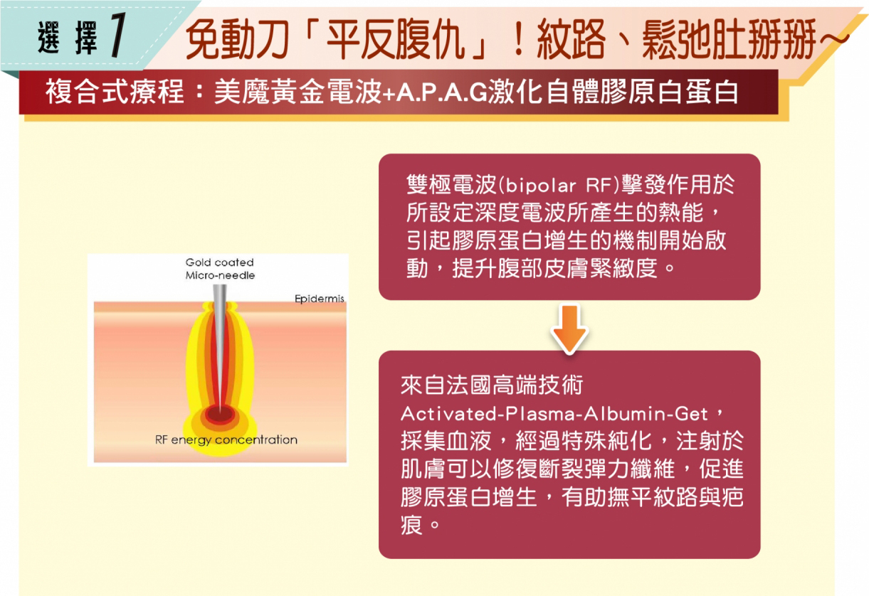 【全新8字線雕】強升8字線化腐朽為完美　免動刀效果堪比拉皮！蝴蝶袖、肚皮也幫您收緊緊，腹部拉提中心三大療程技術，拯救產後準媽咪崩壞肚皮，選擇一，免動刀平反腹肌，紋路、松弛肚掰掰~複合式療程：美魔黃金電波+APAG激化自體膠原白蛋白，雙極電波(bipolar RF)擊發作用於所設定深度電波所產生的熱能，引起膠原蛋白增生的機制開始啟動，提升腹部皮膚緊緻度，來自法國高端技術，Activated-Plasma-Albumin-Get，採集血液，經過特殊純化，注射於肌膚可以修復斷裂彈力纖維，促進膠原蛋白增生，有助於撫平紋路與疤痕，