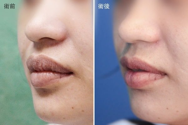 (對比圖)【加個梨窩,讓笑容更甜一點! 謝氏超自然梨渦手術!,真美學診所