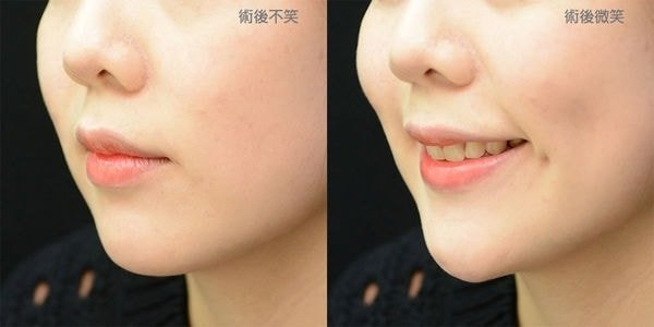 【加個梨窩，讓笑容更甜一點！ 謝氏超自然梨渦手術!，真美學診所，術後微笑，術後不笑