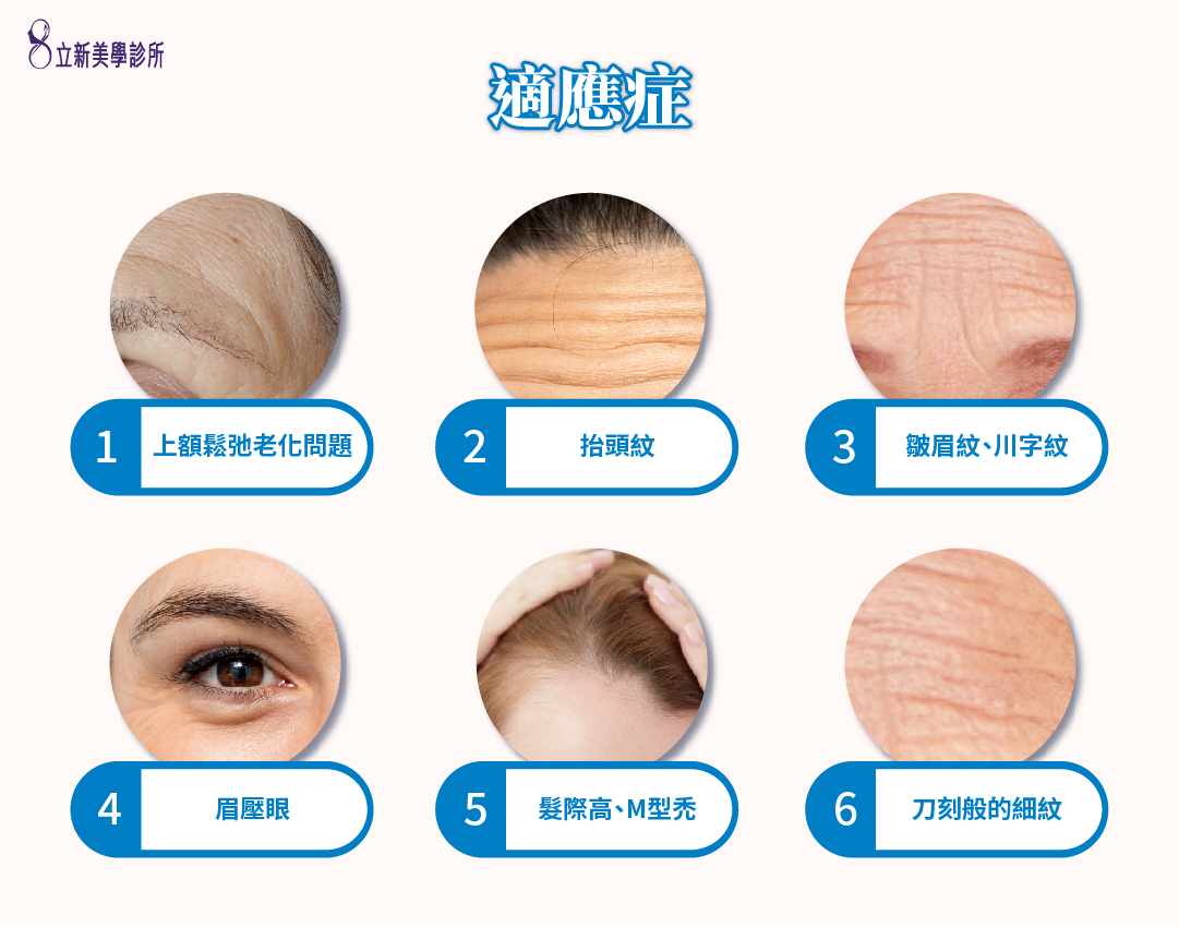 適應症 1.上額鬆弛老化問題 2.抬頭紋 3.皺眉紋、川字紋 4.眉壓眼 5.髮際高、M行禿 6.刀刻般的細紋