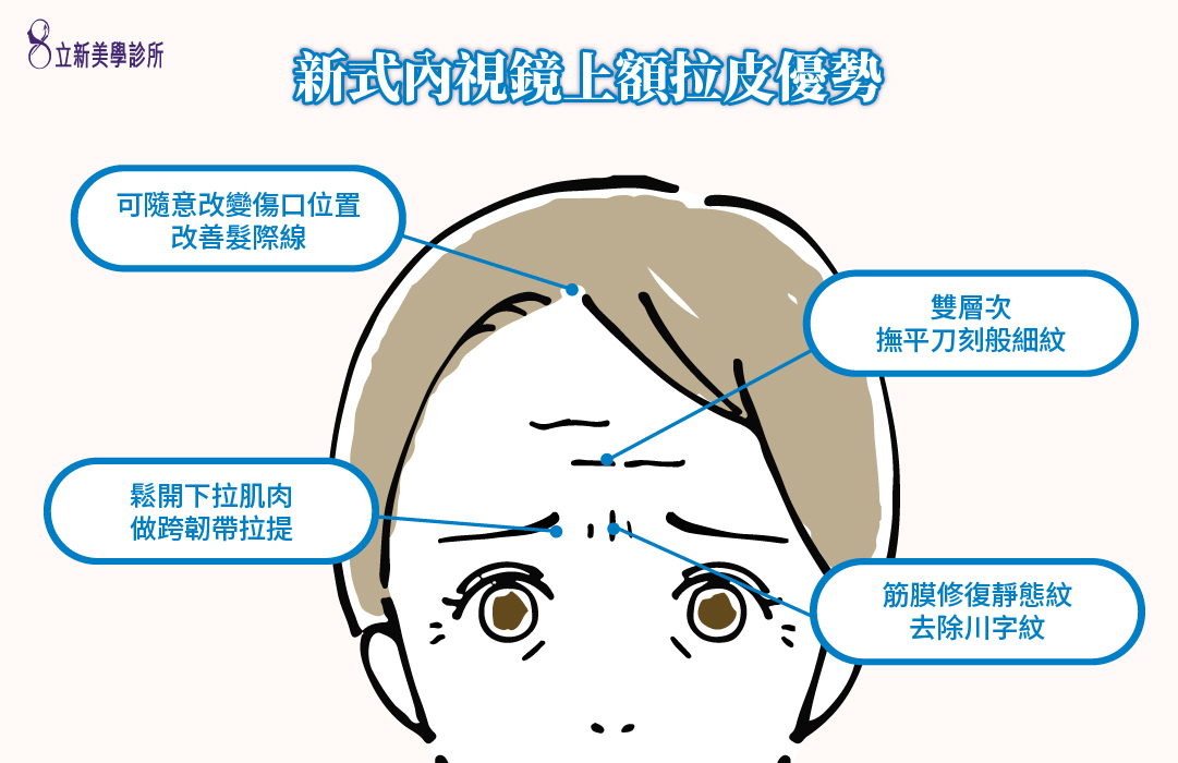 新式內視鏡上額拉皮優勢 可隨意改變傷口位置改善髮際線 鬆開下拉肌肉做韌帶拉提 雙層次撫平刀刻般細紋 筋膜修復靜態紋去除川字紋
