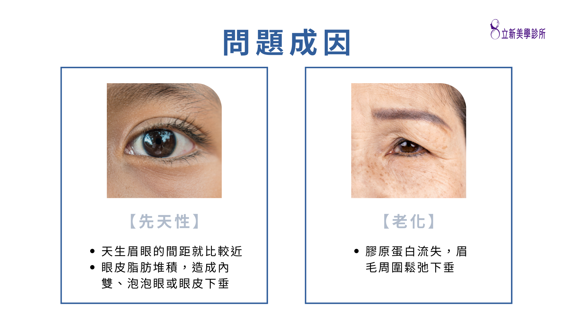 【先天性】 ·天生眉眼的間距就比較近 ·眼皮脂肪堆積,造成內 雙、泡泡眼或眼皮下垂,【老化】 ·膠原蛋白流失,眉 毛周圍鬆弛下垂
